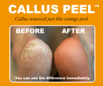 Callus Peel - Image 5